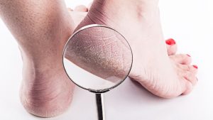 Penyebab Tumit Kaki Retak Dan Cara Mencegahnya Di Rumah