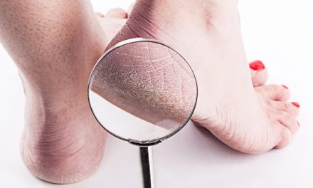 Penyebab Tumit Kaki Retak Dan Cara Mencegahnya Di Rumah